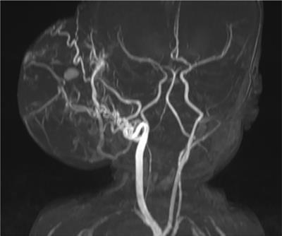 A multi-step approach to the treatment of giant scalp congenital hemangiomas: a report of two cases